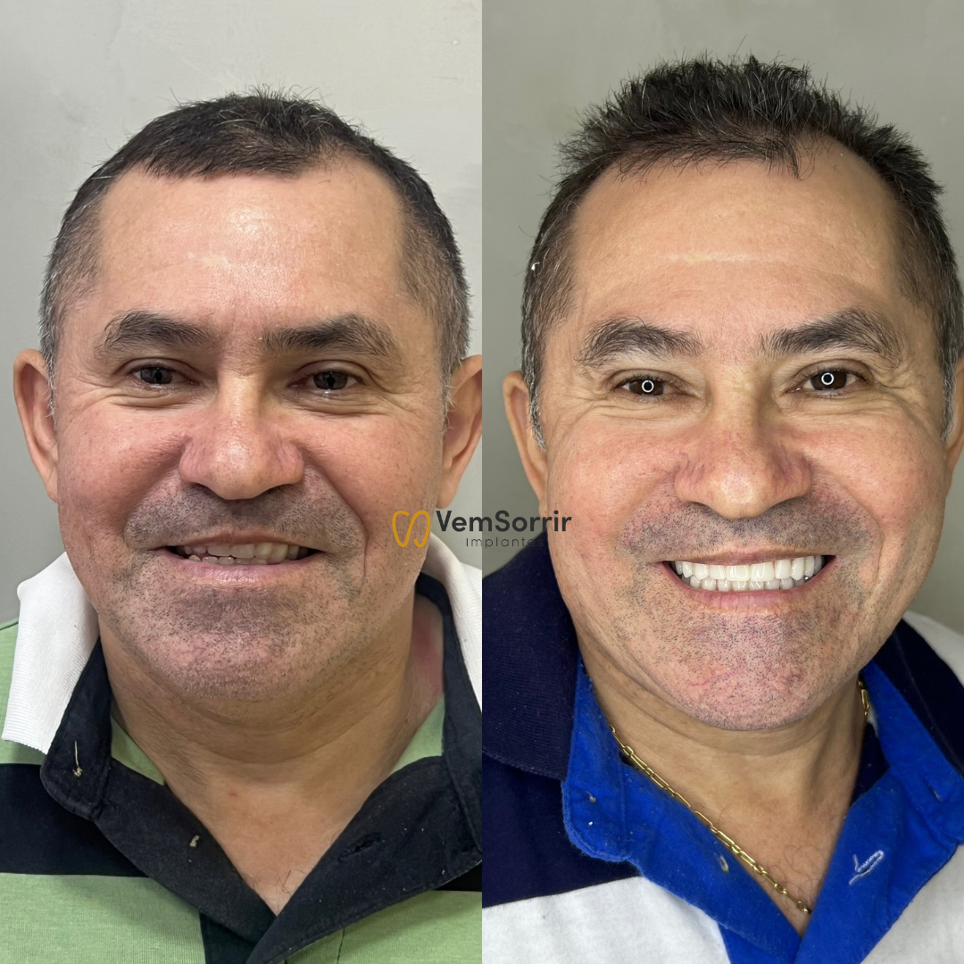 Resultado de Implante 3